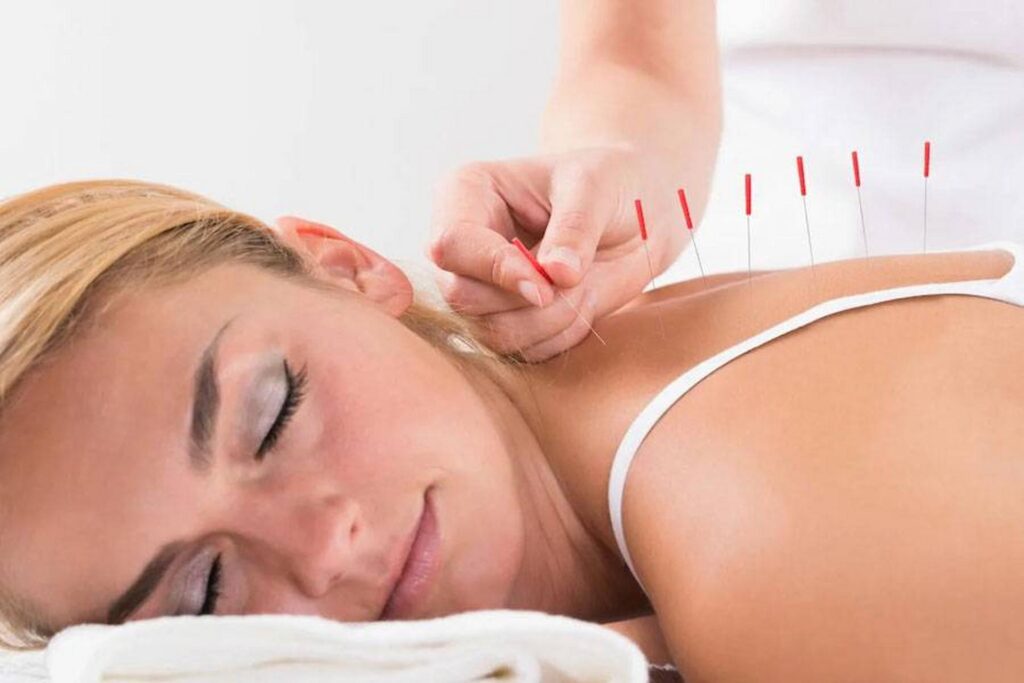 needling therapy